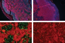 The top two panels show tumors produced by cancer cells. The outer ring of cells (blue) has enough oxygen to survive, but not as much oxygen reaches the inner cells. At top right, tumor cells lack the SHMT2 gene and are unable to survive in this central region, as indicated by the pink stain that marks a protein produced during cell death. At top left, the cells express high levels of SHMT2, allowing some of them to survive, indicated by the blue clusters of cells. The bottom two panels are magnifications of the central tumor regions.