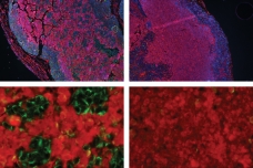 The top two panels show tumors produced by cancer cells. The outer ring of cells (blue) has enough oxygen to survive, but not as much oxygen reaches the inner cells. At top right, tumor cells lack the SHMT2 gene and are unable to survive in this central region, as indicated by the pink stain that marks a protein produced during cell death. At top left, the cells express high levels of SHMT2, allowing some of them to survive, indicated by the blue clusters of cells. The bottom two panels are magnifications of the central tumor regions. 