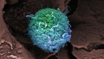 Vanderbilt-led study identifies genes linked to breast cancer in East Asian women.